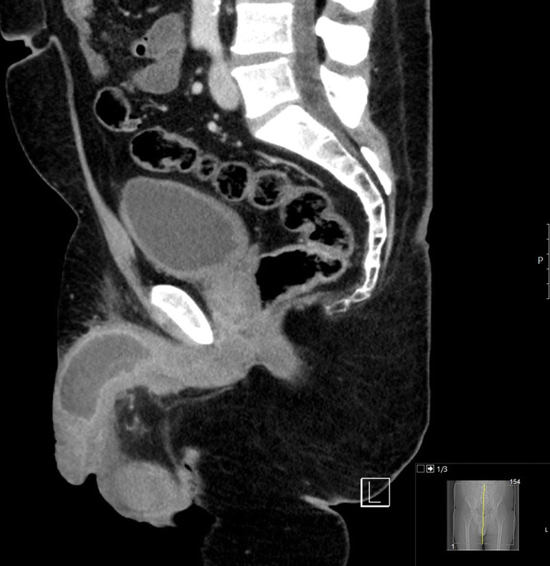 Cavernosal abscess after routine urological surgery.