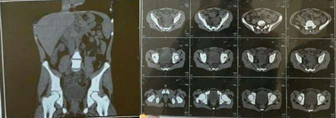 Perforated meckel's diverticulum misdiagnosed as a urinary tract infection in an 11-year-old adolescent: case report of a rare differential diagnosis.