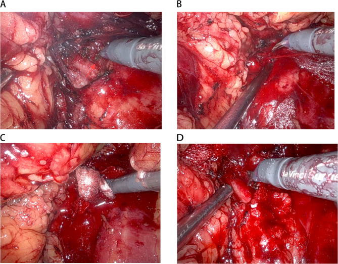 Off-clamp robot-assisted nephron-sparing surgery is associated with less operative time and potential for vascular complication in the treatment of renal angiomyolipoma > 4 cm: a comparative study.