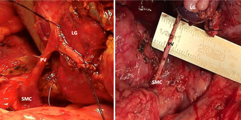 Liver and systemic hemodynamics in cirrhotic children.