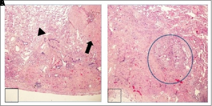 The dark side of pulmonary alveolar proteinosis.