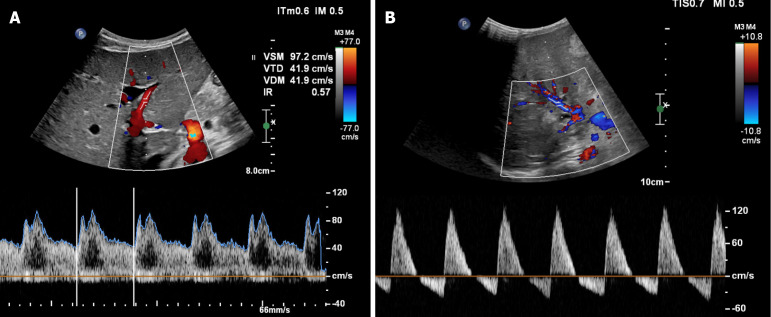 Liver and systemic hemodynamics in cirrhotic children.