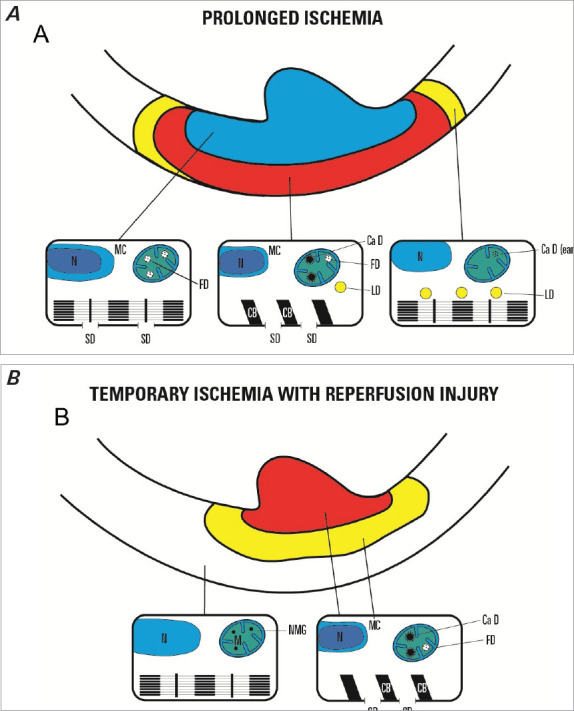 Contributions of Pathobiological and Translational Science to Understanding and Managing Ischemic Heart Disease: Progress, Impediments, and Future Directions.