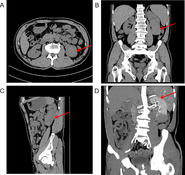Primary renal mucosa-associated lymphoid tissue lymphoma coexisting with immune thrombocytopenia.