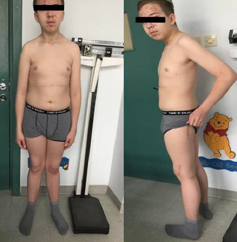 Long-Term Consequences of Misdiagnosis of Parathyroid Adenomas in Pediatric Patients.
