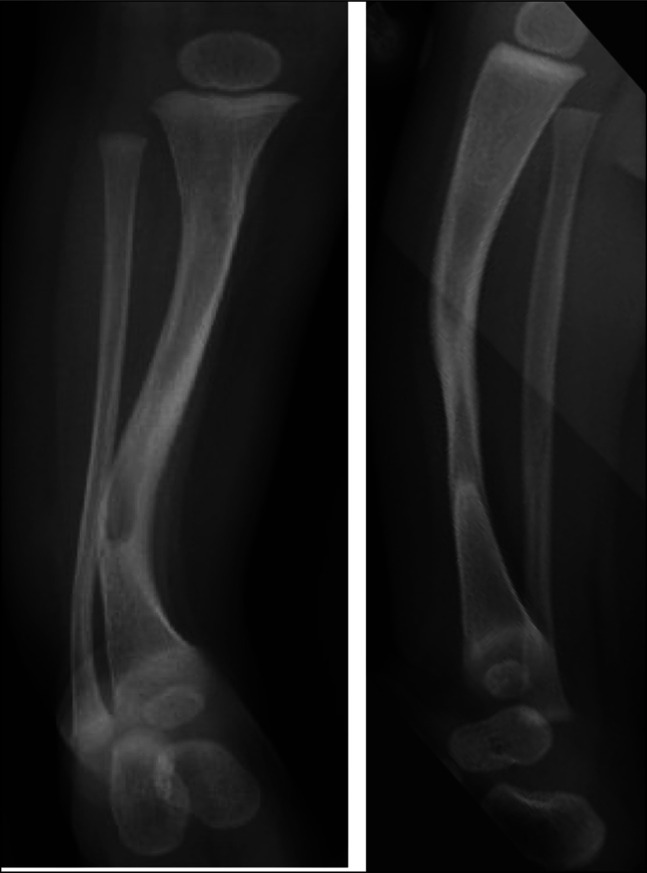 Coincidence of Congenital Pseudarthrosis of the Tibia and Hemihypertrophy in a Patient With Neurofibromatosis Type 1.