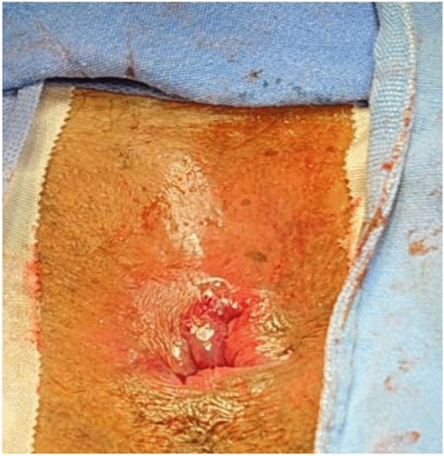 Early results of modified anorectal mucopexy and hemorrhoidoplasty with transanal suture: a 21 patient case report of "Salinas-Cabrera procedure".