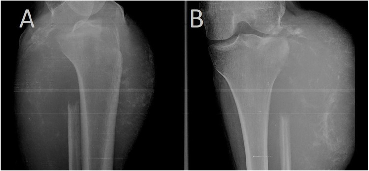 Metastatic Adamantinoma of Fibula to the Lungs: A Rare Case Report.