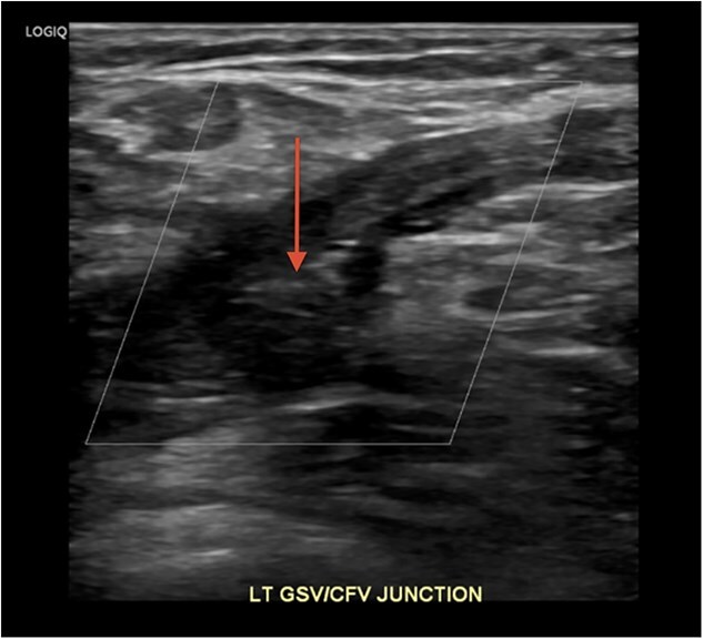 Case report: may-Thurner syndrome: early diagnosis and intervention in a young healthy woman.
