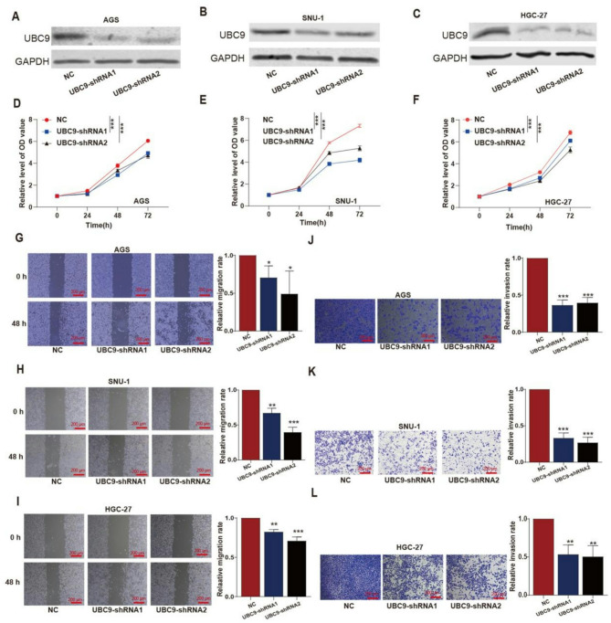 UBC9 overexpression promotes proliferation and metastasis in gastric cancer via ATF2.