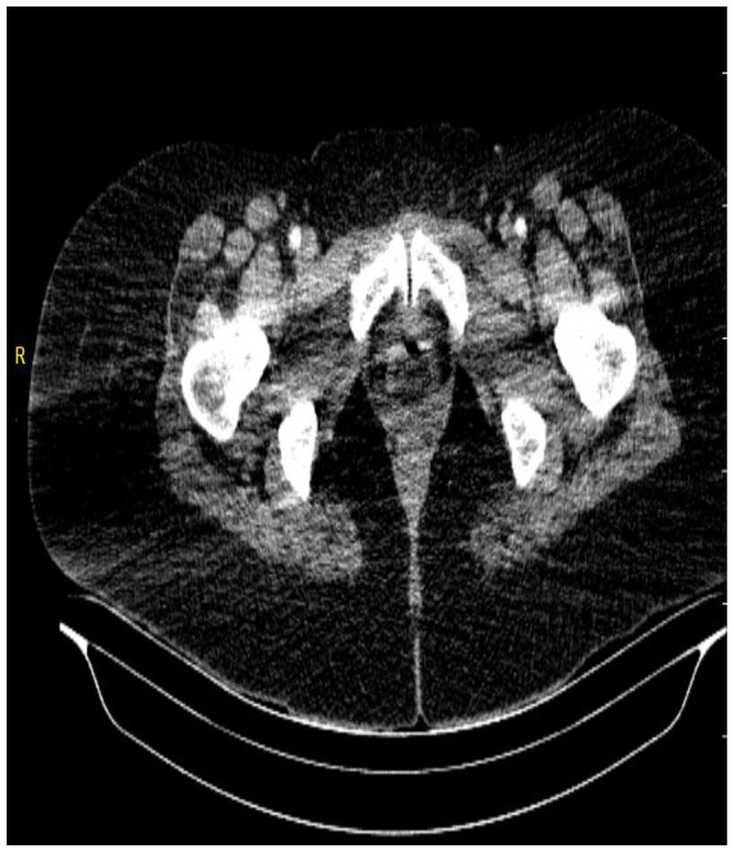 Challenges in Diagnosis and Management of Acute Limb Ischemia 30 Days Postpartum in Lithotomy Position: A Case Report from Somalia Leading to Bilateral Lower Limb Amputation.