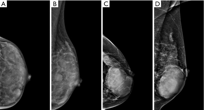 A convenient model based on mammography and magnetic resonance imaging for preoperative differentiation of breast phyllodes tumors and fibroadenomas.