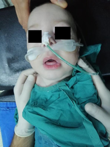 Anesthesia Management in a Crisponi Syndrome Patient Undergoing Tracheotomy Surgery.