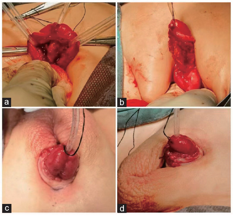 Comparative analysis of isolated male epispadias: concealed versus nonconcealed cases in a Chinese tertiary hospital.