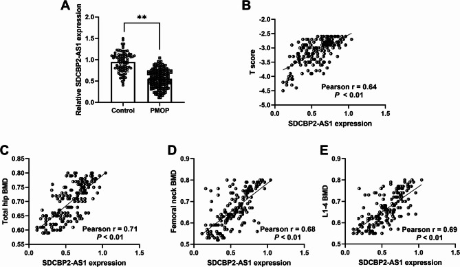 LncRNA SDCBP2-AS1 is a putative biomarker for postmenopausal osteoporosis and promotes osteogenic differentiation of BMSCs by regulating miR-361-3p.