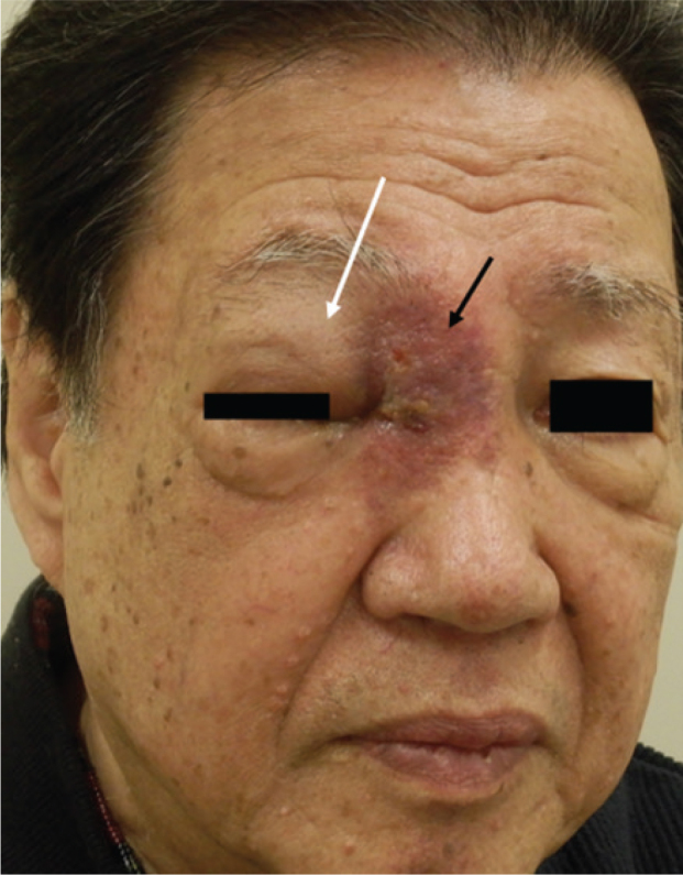Skin Erosion on the Nasal Root with Marked Right Eyelid Swelling: A Quiz.