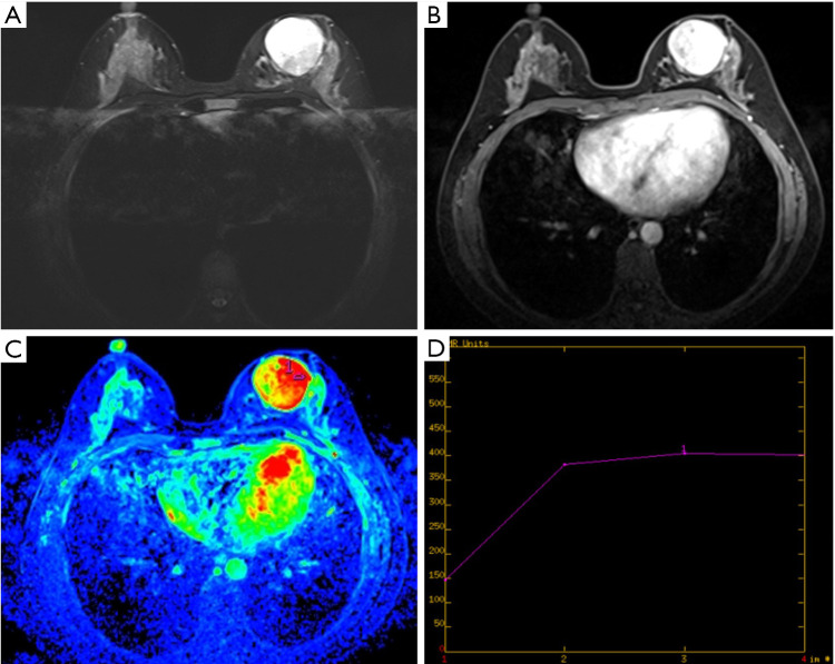 A convenient model based on mammography and magnetic resonance imaging for preoperative differentiation of breast phyllodes tumors and fibroadenomas.
