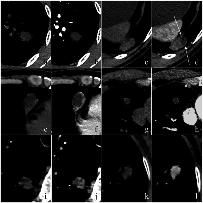 Exploring the key clinical and CT characteristics of granulomas mimicking peripheral lung cancers: a case-control study.