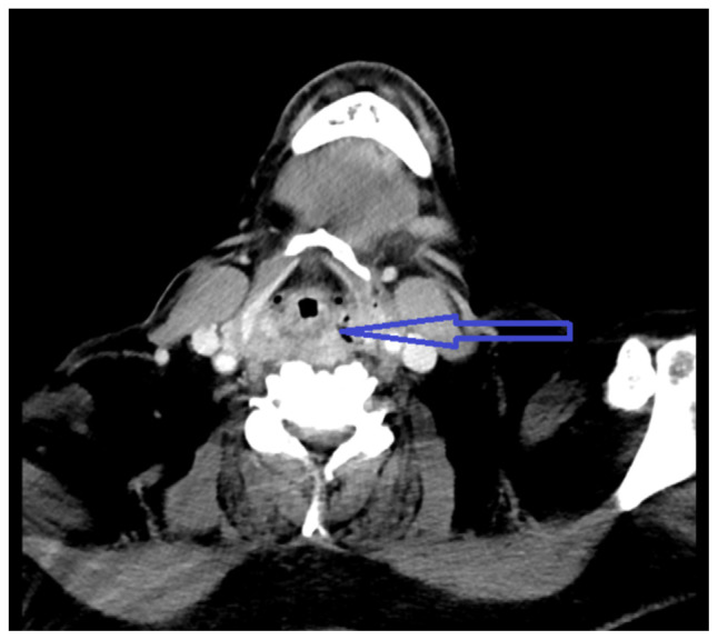 Deep Neck Space Infection as a Complication of Transesophageal Echocardiogram for Atrial Flutter Ablation.