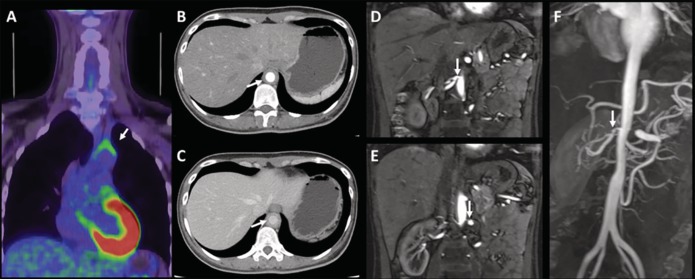 Asymptomatic hypertension and bilateral renal artery stenosis in Takayasu arteritis.
