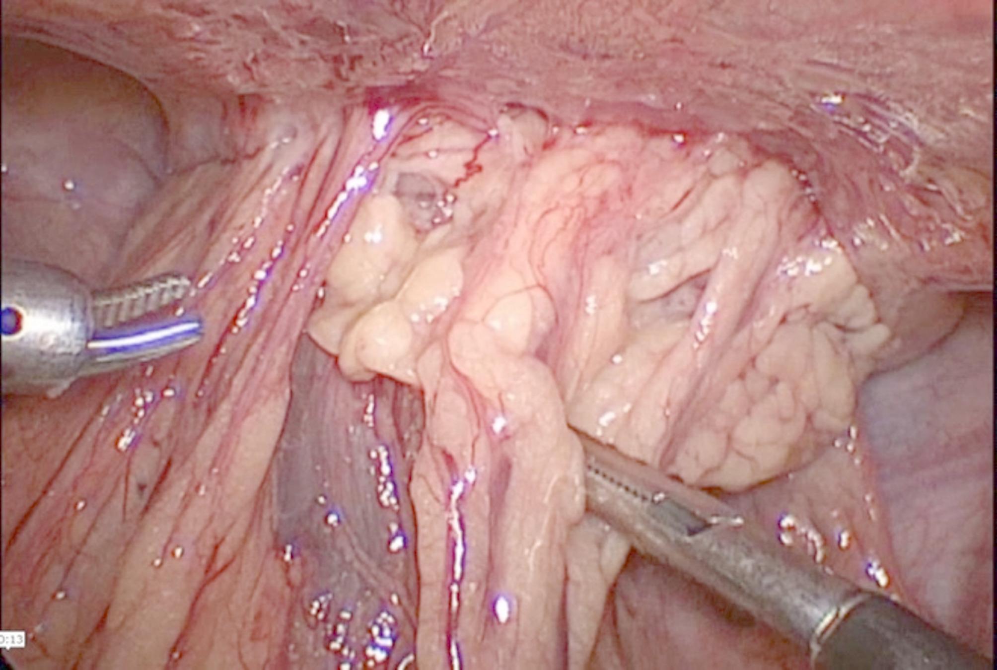 Perforated meckel's diverticulum misdiagnosed as a urinary tract infection in an 11-year-old adolescent: case report of a rare differential diagnosis.