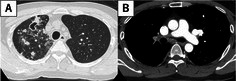 A Case of Nontuberculous Mycobacterial Pulmonary Disease Complicating Massive Pulmonary Embolism.