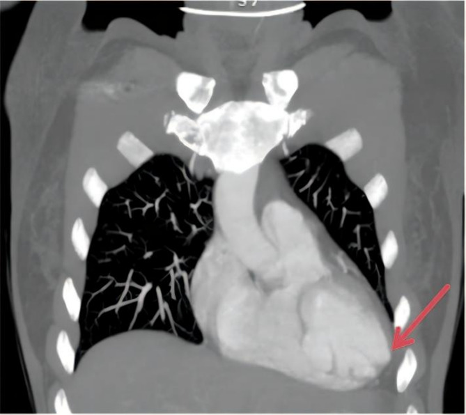 A case of hypoparathyroidism with cardiovascular complications: interventricular septal dissecting aneurysm in a middle-aged woman.
