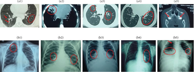Major Histocompatibility Complex Class II Deficiency Beyond Infancy.