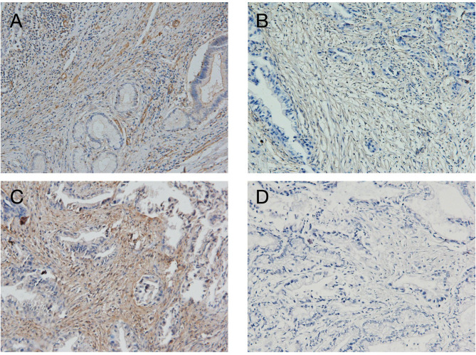 Association of α-SMA/FAP-positive cancer-associated fibroblasts with clinicopathological features and prognosis in extrahepatic cholangiocarcinoma.