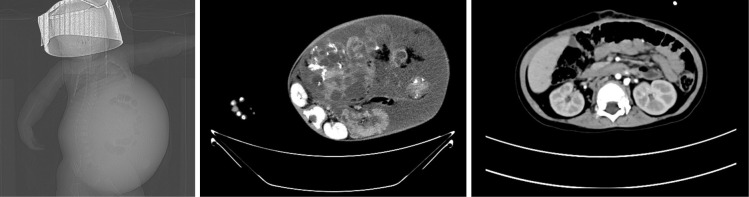 Clinical insights from the management of a giant immature teratoma in an infant-a case report.