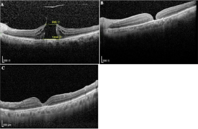 Modified two-needle technique of air/fluid exchange for in-office treatment of unhealed macular hole.