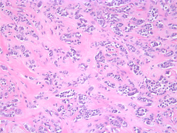 A Case of False-Negative Results in the One-Step Nucleic Acid Amplification Assay for Sentinel Lymph Node Metastasis in Breast Cancer with Low Cytokeratin 19 Expression.