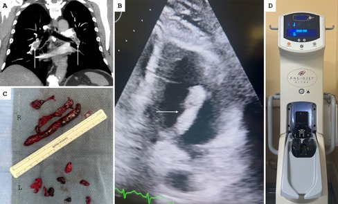 Percutaneous Thrombectomy Using AngioJet in Acute Pulmonary Embolism With Clot in Transit.
