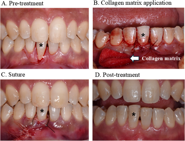 Pink esthetic treatment of gingival recession, black triangle, and gummy smile: a narrative review.