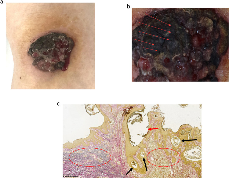 Basal Cell Carcinoma Arising Within a Favre-Racouchot Syndrome Lesion: A Rare Case and Literature Review.