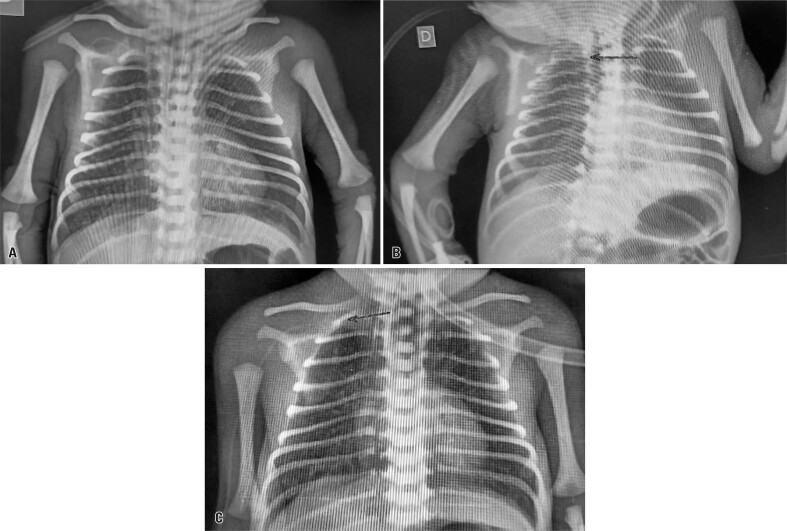 Cardiac tamponade in a newborn caused by a peripherally inserted central catheter: case report.