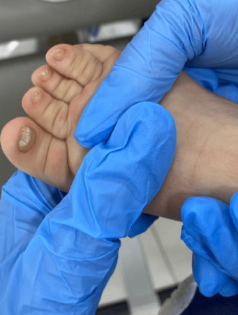 A Newly Documented Rare Case of Pachyonychia Congenita II in a Three-Month-Old Baby.