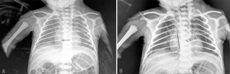 Cardiac tamponade in a newborn caused by a peripherally inserted central catheter: case report.