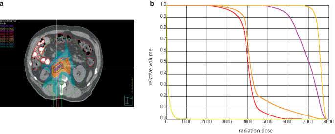 Potential radiotherapy-related reactivation of immune checkpoint inhibitor hepatitis.