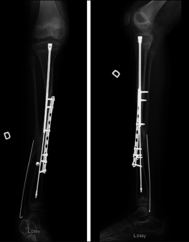 Coincidence of Congenital Pseudarthrosis of the Tibia and Hemihypertrophy in a Patient With Neurofibromatosis Type 1.
