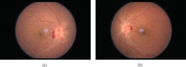 Neuro-Ophthalmic Manifestation Associated With COVID-19 in a Tertiary Eye Center in Nepal.