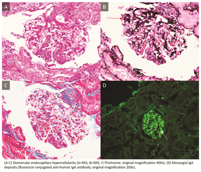 An Unusual Presentation of IgA Vasculitis and IgA Nephropathy: A Case Report.