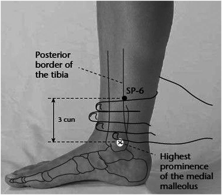 Effect of Spleen 6 Point Acupressure on Severity of Labor Pain, Duration of Labor, and Women's Satisfaction.