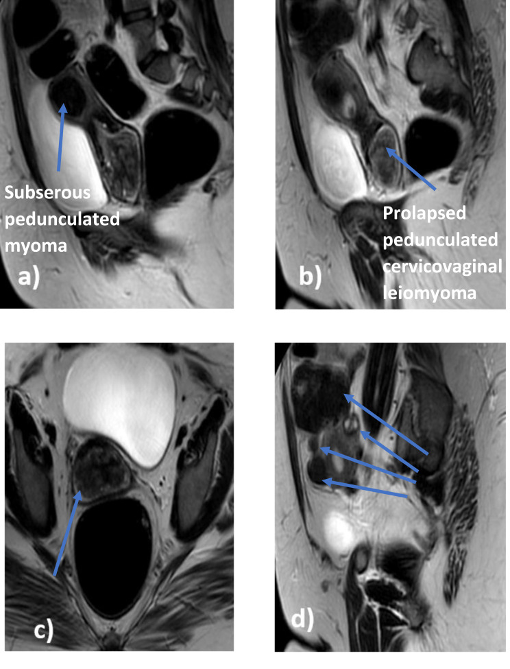 Hymen-Sparing Myomectomy: Innovative Laparoscopic Approach for Prolapsed Pedunculated Cervicovaginal Leiomyoma in a Virgin Case.