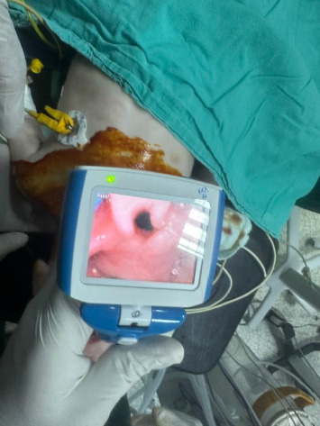 Anesthesia Management in a Crisponi Syndrome Patient Undergoing Tracheotomy Surgery.