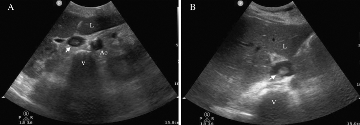 Inferior Vena Cava Thrombi Related to Intravascular Temperature Management Catheters.