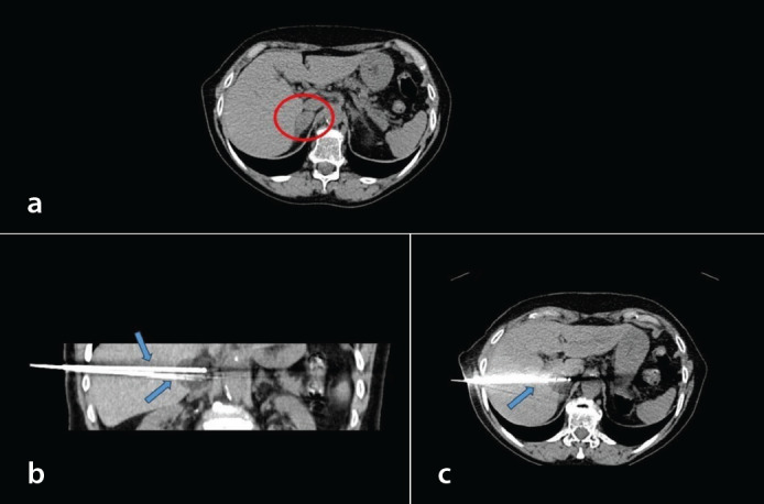 Computed tomography-guided cryoablation in treating adrenal metastases: a retrospective single-center study