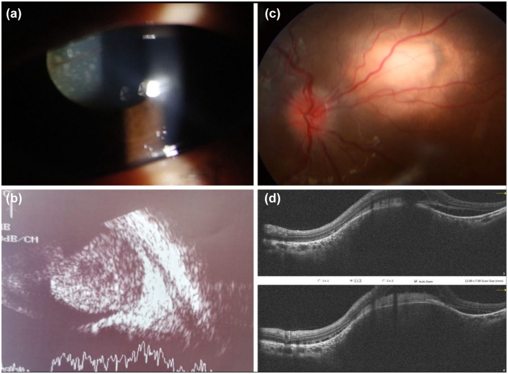 Bilateral intraocular masses in a child as a first presentation of disseminated tuberculosis: case report.