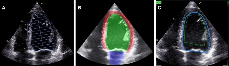 Real-time guidance and automated measurements using deep learning to improve echocardiographic assessment of left ventricular size and function.