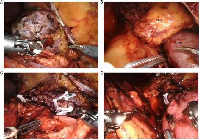 Off-clamp robot-assisted nephron-sparing surgery is associated with less operative time and potential for vascular complication in the treatment of renal angiomyolipoma > 4 cm: a comparative study.